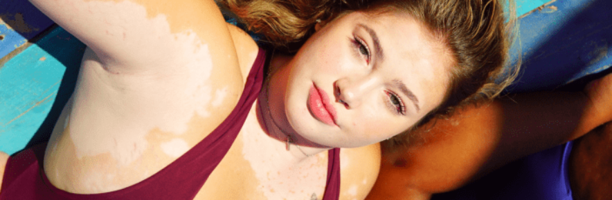 femme atteinte du vitiligo qui bronze